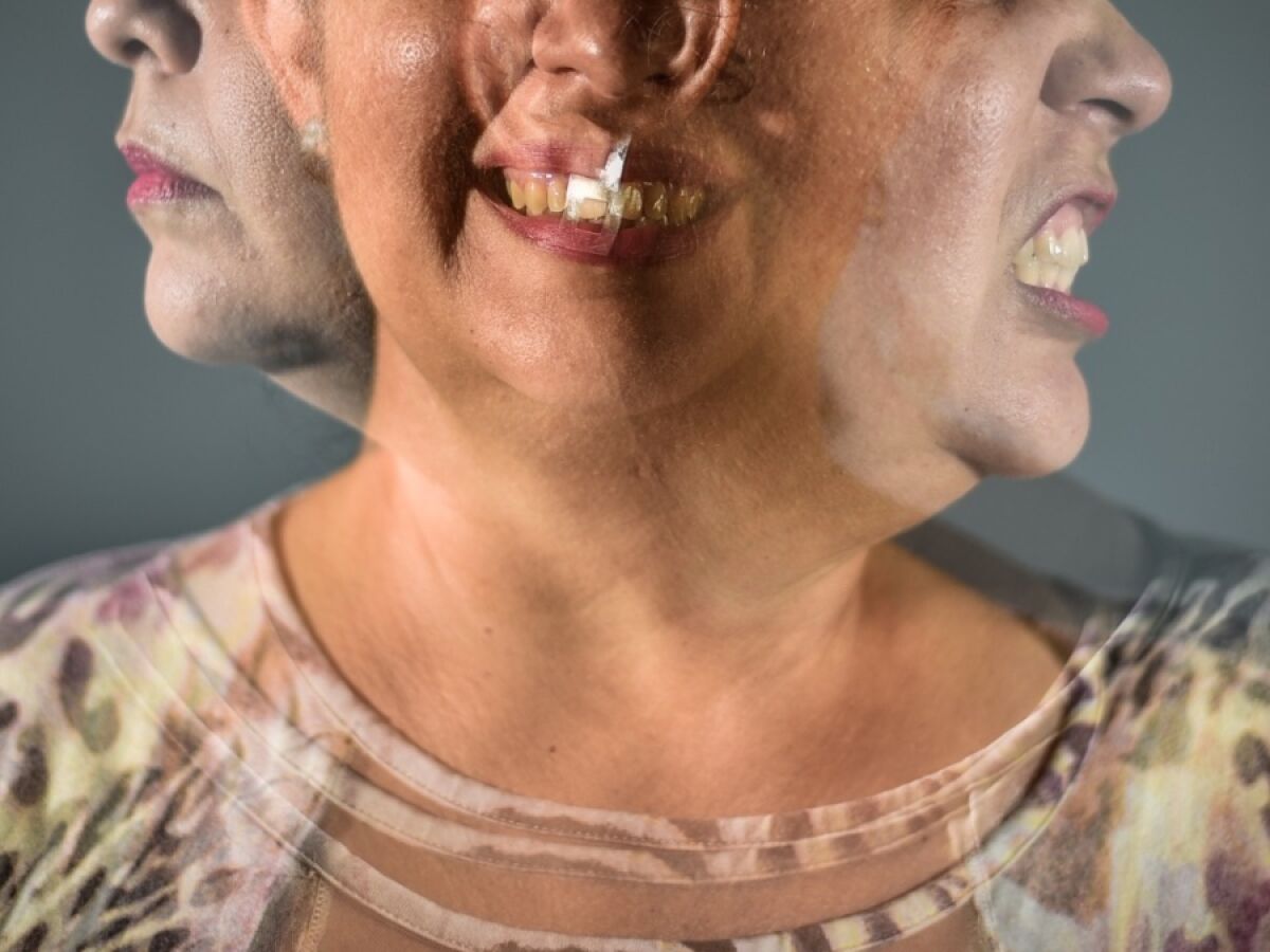 Transtorno bipolar é marcado por dois polos contrários de estado de humor