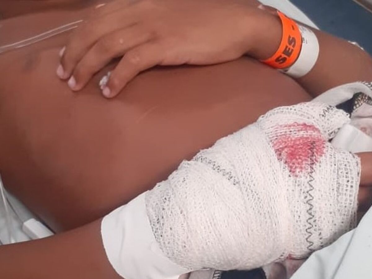 Atleta de projeto social do Sport sofre grave lesão após bomba estourar em sua mão