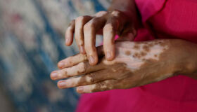 Vitiligo: saiba as causas das manchas na pele e os cuidados necessários