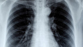 Agosto Branco: campanha conscientiza sobre câncer de pulmão