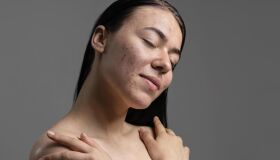 Como se livrar da acne? Conheça os tratamentos recomendados