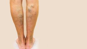 Agosto Azul Vermelho: campanha alerta para os cuidados com a saúde vascular