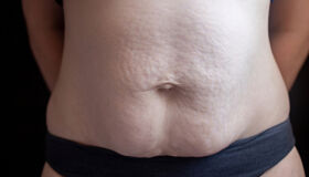 Comum na gravidez e no pós-parto, diástase abdominal vai além da estética e merece atenção