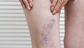 Queixas com varizes sobem até 30% no verão; saiba como amenizar os incômodos