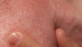 Herpes-zóster pode levar à morte? Infectologista responde e fala sobre prevenção