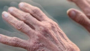 Cientistas relatam possível caso de Parkinson relacionado à Covid-19
