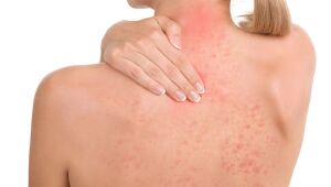 Psoríase: dermatologista alerta para tratamento da doença