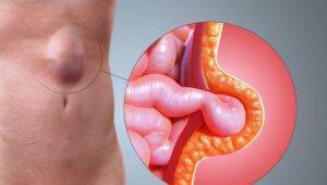 Entenda o que são e como acontecem as hérnias abdominais