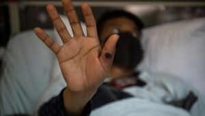 Paciente peruano relata seu calvário ao contrair a varíola do macaco