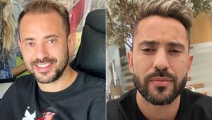 Não foi só Everton Ribeiro: veja antes e depois de jogadores que fizeram transplante capilar