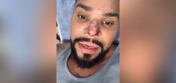 Naldo Benny divulga que toma Viagra para curar necrose no nariz, entenda o tratamento
