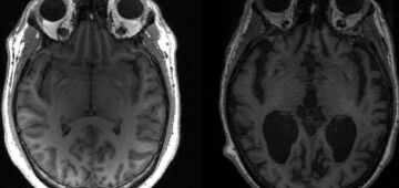 Alzheimer: novo medicamento que retarda perda cognitiva chega ao Brasil