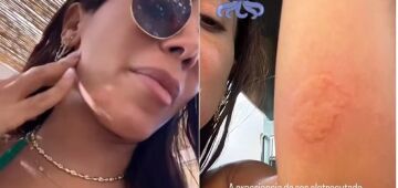 Anitta é "eletrocutada" por água viva: veja os sintomas mais perigosos da queimação e o que fazer