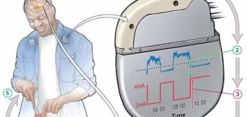 Parkinson: marcapasso feito com IA reduz em 50% os sintomas da doença; veja como funciona