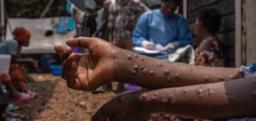 China relata cinco casos da nova variante de mpox