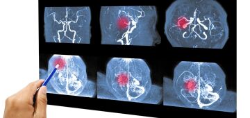 Aneurisma Cerebral: conheça os riscos e opções de tratamento