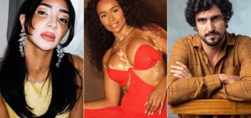 Vitiligo: além da candidata do Miss Universo, conheça três famosos que convivem com a condição