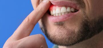 Doenças periodontais: prevenção e tratamento