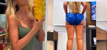 Lipedema: entenda a condição que afeta a modelo Yasmin Brunet e conheça o tratamento