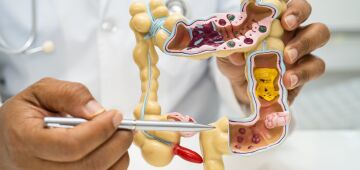 Pacientes com câncer colorretal são diagnosticados em estágio avançado