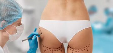 Roundglúteo, sustentação de PDO: os novos tratamentos que as celebridades fazem para moldar o bumbum