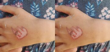 Menina de sete anos tem mão e genital queimadas pela mãe em Olinda; Polícia investiga o caso