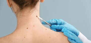 Primavera chega com alerta para cuidados com a pele e prevenção ao câncer