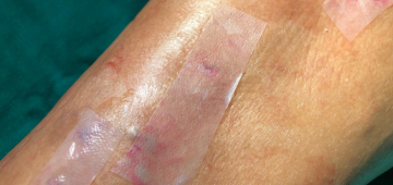 Pesquisadores da UFPE atestam eficácia de curativo pós-cirúrgico feito a partir da cana-de-açúcar