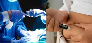 Cirurgia bariátrica para perda de peso mostra maiores benefícios a longo prazo do que remédios GLP-1