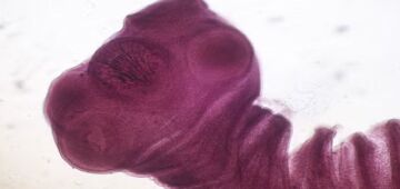 Epilepsia: larva de tênia é a principal causa da doença em regiões de baixa e de média renda