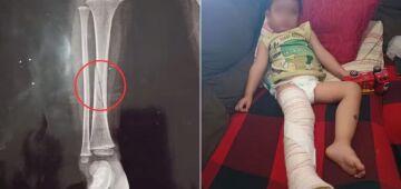 Menino tem a perna quebrada durante briga em creche de São Paulo; MP investiga