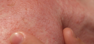 Herpes-zóster pode levar à morte? Infectologista responde e fala sobre prevenção