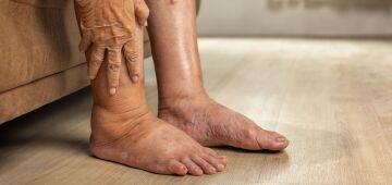 Pé diabético: complicação silenciosa do diabetes pode levar a infecções graves e amputações