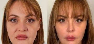 Veja o antes e depois da atriz Gaby Spanic, a "Usurpadora", após harmonização facial
