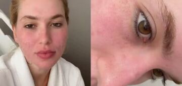 Virginia Fonseca: entenda o que é o laser de CO2 profundo, tratamento feito pela influenciadora