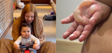 Filho de Viih Tube, de 1 ano, sofre queimadura e passa por cirurgia