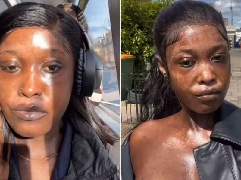 Influencer com vitiligo mostra o passo-a-passo do desenvolvimento da doença ao longo do tempo - Folha de Pernambuco