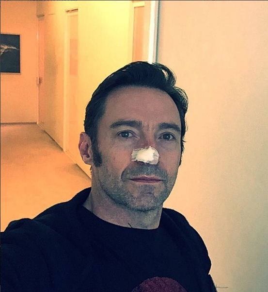 Hugh Jackman fez biópsia no nariz