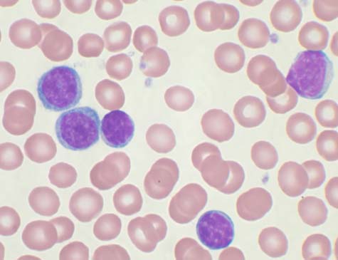 Proliferação de linfócitos em sangue de portador de Leucemia