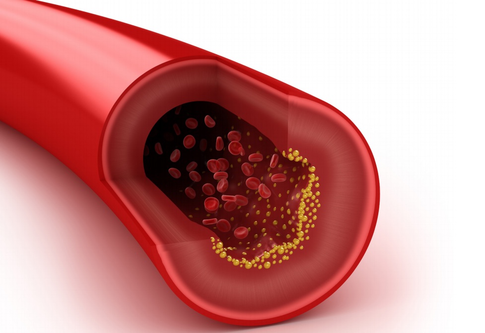 Colesterol alto: novo comprimido reduz a forma genética da doença em quase 86%