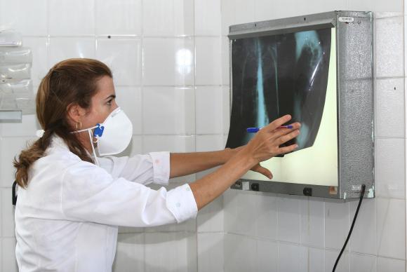 É necessário ficar atento aos sintomas da tuberculose para dar início ao tratamento e, com isso, interromper a contaminação das outras pessoas