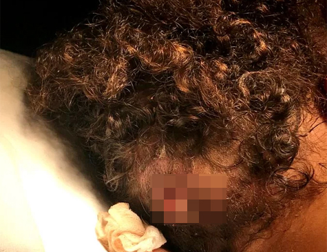 Criança passou por cirurgia para a retirada das larvas