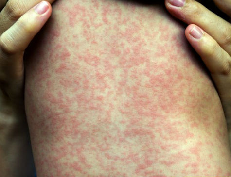 O epicentro do surto de sarampo é o condado de Gaines, lar de uma importante população menonita, uma seita cristã com um histórico de relutância em relação às vacinas