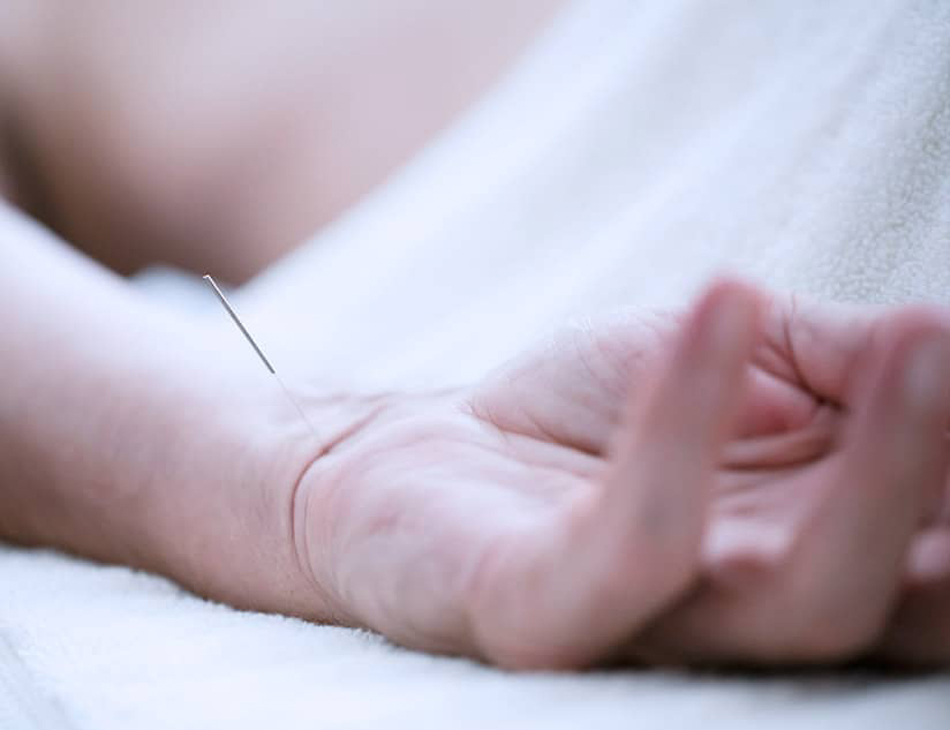 Acupuntura