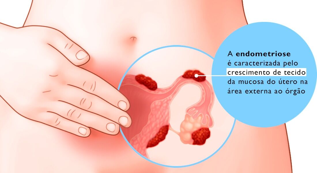 A mulher com Endometriose pode menstruar? - Humanize Diagnósticos