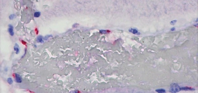 Micrografia de cérebro de criança com a SIM-P associada à Covid-19 e com encefalopatia