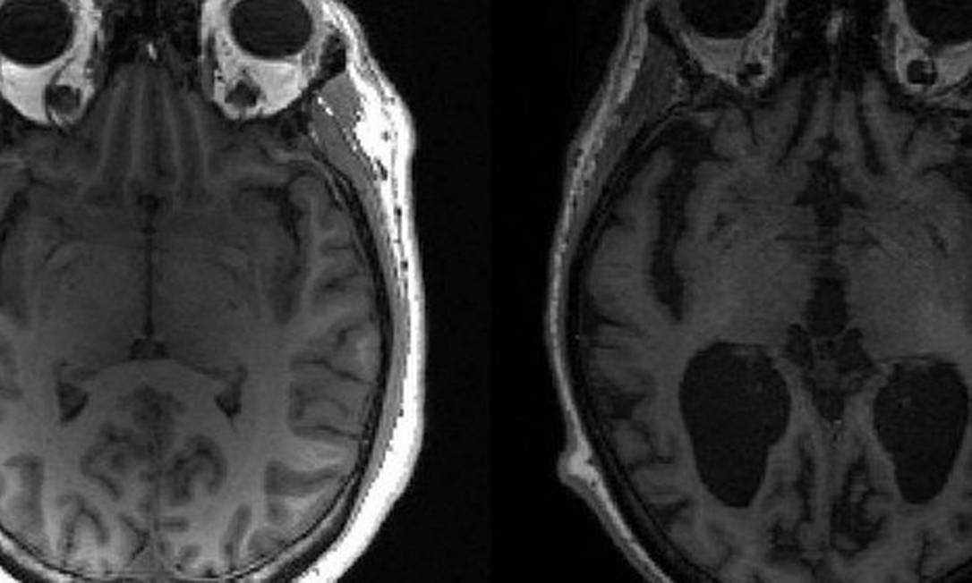 Imagem mostra cérebro saudável à esquerda e cérebro com Alzheimer à direita