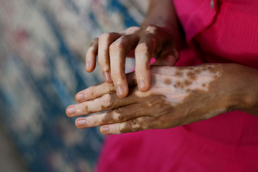 Vitiligo é caracterizado por manchas brancas na pele