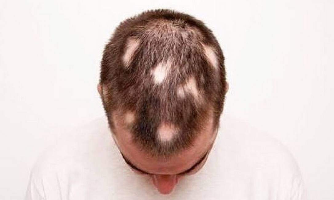 Alopecia 