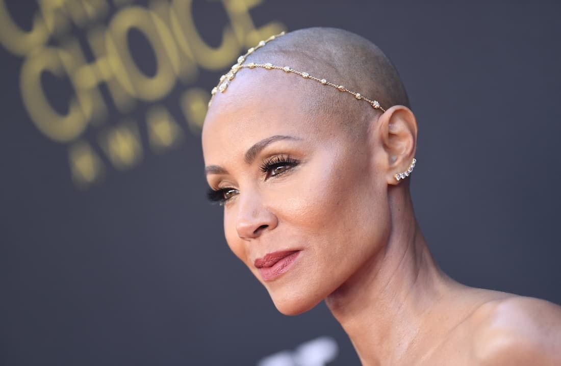 Jada Pinkett Smith tem diagnóstico de alopecia